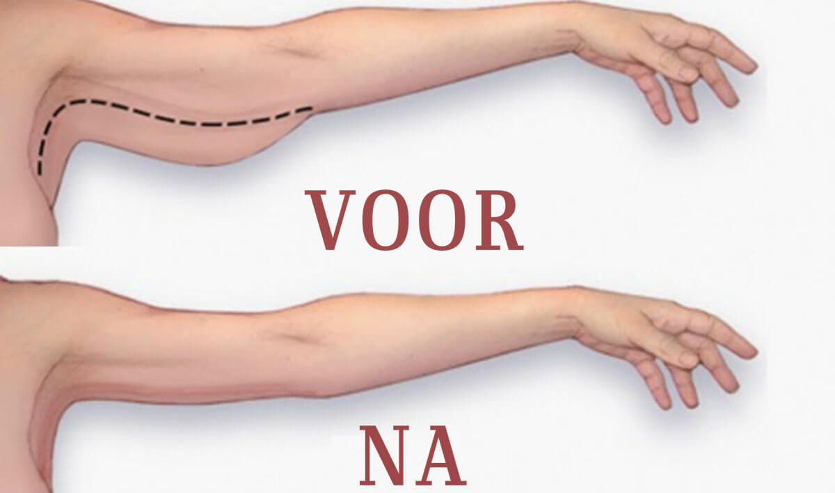 arm vet kwijtraken