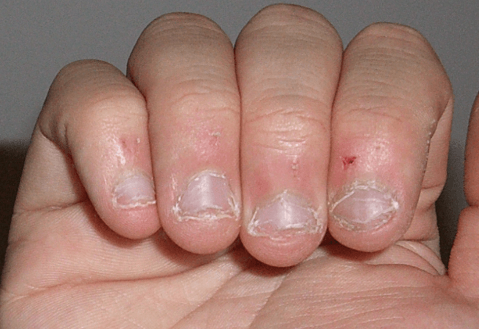 Verslavend maar het ziet er niet uit: nagelbijten! Zo kom je makkelijk