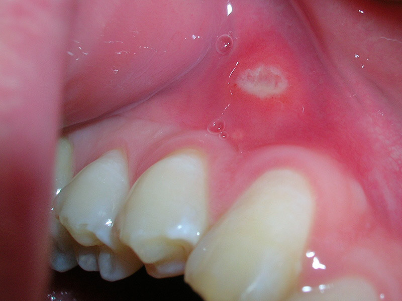 Heb je ook wel eens van die pijnlijke blaasjes in je mond? Zó kom je van aften af! Heb je ook wel eens van die pijnlijke blaasjes in je mond? Zó kom je van aften af!